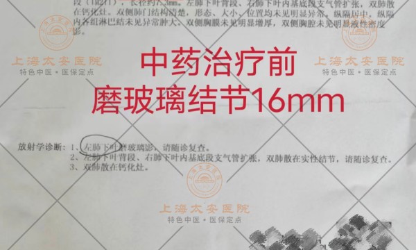 16mm磨玻璃结节会癌变吗？中医能治好肺结节吗？章晓辉主任深度解析！